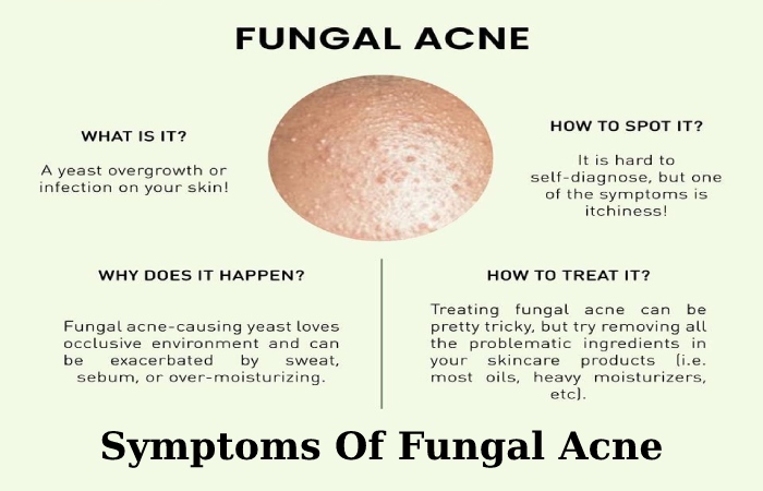 Fungal Acne On Body