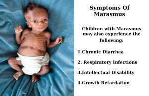 Marasmus – Symptoms, Causes, Risks, How is Marasmus Treated?