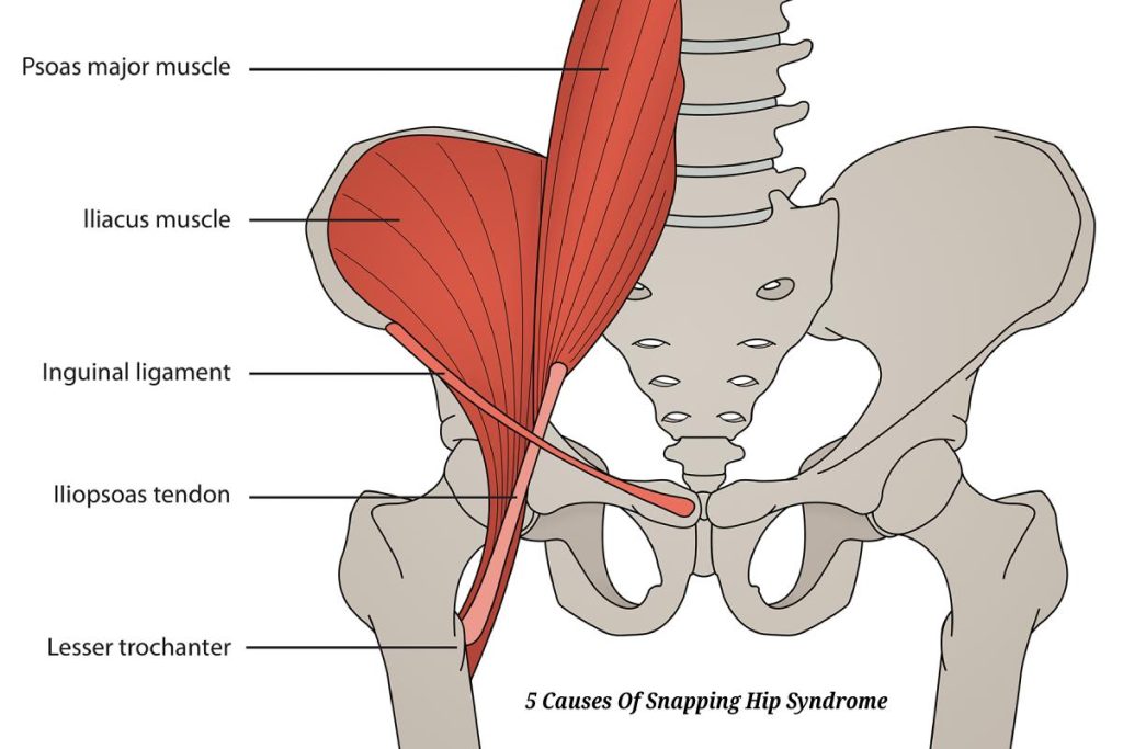 5 Causes Of Snapping Hip Syndrome